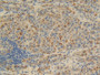 DAB staining on IHC-P; Samples: Human Liver cancer Tissue; Primary Ab: 20µg/ml Rabbit Anti-Human FKBP1B Antibody Second Ab: 2µg/mL HRP-Linked Caprine Anti-Rabbit IgG Polyclonal Antibody