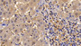 DAB staining on IHC-P; Samples: Human Liver Cirrhosis Tissue; Primary Ab: 30ug/ml Rabbit Anti-Human Bcl2L Antibody Second Ab: 2µg/mL HRP-Linked Caprine Anti-Rabbit IgG Polyclonal Antibody