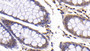 DAB staining on fromalin fixed paraffin- embedded kidney cancer tissue)