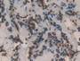 DAB staining on IHC-P; Samples: Human Breast cancer Tissue;  Primary Ab: 20µg/ml Rabbit Anti-Human T