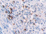 DAB staining on IHC-P; Samples: Human Colorectal cancer Tissue)