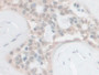 DAB staining on IHC-P; Samples: Human Breast cancer Tissue; Primary Ab: 10µg/ml Rabbit Anti-Human PCSK1 Antibody Second Ab: 2µg/mL HRP-Linked Caprine Anti-Rabbit IgG Polyclonal Antibody
