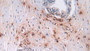 DAB staining on IHC-P; Samples: Human Prostate Tissue; Primary Ab: 30µg/ml Rabbit Anti-Human DEFa3 Antibody Second Ab: 2µg/mL HRP-Linked Caprine Anti-Rabbit IgG Polyclonal Antibody