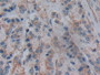 DAB staining on IHC-P; Samples: Human Prostate cancer Tissue; Primary Ab: 10µg/ml Rabbit Anti-Human NT5C3 Antibody Second Ab: 2µg/mL HRP-Linked Caprine Anti-Rabbit IgG Polyclonal Antibody
