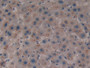 DAB staining on IHC-P; Samples: Human Liver cancer Tissue