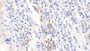 DAB staining on IHC-P; Samples: Human Lymphoma Tissue; Primary Ab: 20μg/ml Rabbit Anti-Human DPP3 Antibody Second Ab: 2µg/mL HRP-Linked Caprine Anti-Rabbit IgG Polyclonal Antibody