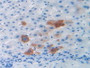 DAB staining on IHC-P; Samples: Human Liver Cancer Tissue