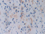 DAB staining on IHC-P; Samples: Human Prostate cancer Tissue; Primary Ab: 20µg/ml Rabbit Anti-Human TOP3 Antibody Second Ab: 2µg/mL HRP-Linked Caprine Anti-Rabbit IgG Polyclonal Antibody