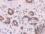 DAB staining on IHC-P; Samples: Human Pancreatic cancer Tissue; Primary Ab: 10µg/ml Rabbit Anti-Human KRT6C Antibody Second Ab: 2µg/mL HRP-Linked Caprine Anti-Rabbit IgG Polyclonal Antibody