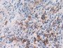 DAB staining on IHC-P; Samples: Human Lung Cancer Tissue