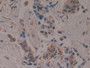 DAB staining on IHC-P; Samples: Human Breast cancer Tissue; Primary Ab: 10µg/ml Rabbit Anti-Human APOA1BP Antibody Second Ab: 2µg/mL HRP-Linked Caprine Anti-Rabbit IgG Polyclonal Antibody