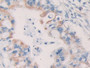 DAB staining on IHC-P; Samples: Human Bile duct cancer Tissue; Primary Ab: 10µg/ml Rabbit Anti-Human KIR2DL2 Antibody Second Ab: 2µg/mL HRP-Linked Caprine Anti-Rabbit IgG Polyclonal Antibody