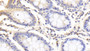 DAB staining on IHC-P; Samples: Human Colon Tissue; Primary Ab: 20μg/ml Rabbit Anti-Human ABCB10 Antibody Second Ab: 2µg/mL HRP-Linked Caprine Anti-Rabbit IgG Polyclonal Antibody
