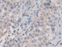 DAB staining on IHC-P; Samples: Human Lung cancer Tissue; Primary Ab: 30µg/ml Rabbit Anti-Human ABCA3 Antibody Second Ab: 2µg/mL HRP-Linked Caprine Anti-Rabbit IgG Polyclonal Antibody