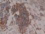 Figure. DAB staining on IHC-P; Samples: Human Skin Cancer Tissue.