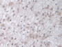 DAB staining on IHC-P; Samples: Human Glioma Tissue.