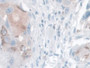 DAB staining on IHC-P; Samples: Human Breast cancer Tissue;  Primary Ab: 10µg/ml Rabbit Anti-Human K