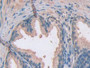 DAB staining on IHC-P; Samples: Human Prostate Tissue; Primary Ab: 30µg/ml Rabbit Anti-Human ATXN10 Antibody Second Ab: 2µg/mL HRP-Linked Caprine Anti-Rabbit IgG Polyclonal Antibody