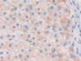 DAB staining on IHC-P; Samples: Human Liver cancer Tissue; Primary Ab: 20µg/ml Rabbit Anti-Human RNASE8 Antibody Second Ab: 2µg/mL HRP-Linked Caprine Anti-Rabbit IgG Polyclonal Antibody