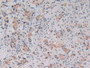 DAB staining on IHC-P; Samples: Human Prostate Gland Cancer Tissue.