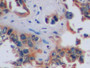DAB staining on IHC-P; Samples: Human Lung cancer Tissue; Primary Ab: 10µg/ml Rabbit Anti-Human CA9 Antibody Second Ab: 2µg/mL HRP-Linked Caprine Anti-Rabbit IgG Polyclonal Antibody