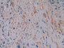 DAB staining on IHC-P; Samples: Human Prostate cancer Tissue; Primary Ab: 10µg/ml Rabbit Anti-Human FTL Antibody Second Ab: 2µg/mL HRP-Linked Caprine Anti-Rabbit IgG Polyclonal Antibody