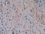 DAB staining on IHC-P; Samples: Human Prostate cancer Tissue)