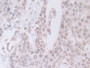 DAB staining on IHC-P; Samples: Human Prostate cancer Tissue; Primary Ab: 30µg/ml Rabbit Anti-Human XRCC5 Antibody Second Ab: 2µg/mL HRP-Linked Caprine Anti-Rabbit IgG Polyclonal Antibody