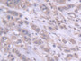 DAB staining on IHC-P; Samples: Human Breast cancer Tissue