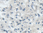 DAB staining on IHC-P; Samples: Human Glioma Tissue; Primary Ab: 20µg/ml Rabbit Anti-Human IARS Antibody Second Ab: 2µg/mL HRP-Linked Caprine Anti-Rabbit IgG Polyclonal Antibody