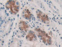 DAB staining on IHC-P; Samples: Human Stomach cancer Tissue; Primary Ab: 20µg/ml Rabbit Anti-Human KARS Antibody Second Ab: 2µg/mL HRP-Linked Caprine Anti-Rabbit IgG Polyclonal Antibody