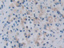 DAB staining on IHC-P; Samples: Human Prostate cancer Tissue; Primary Ab: 20µg/ml Rabbit Anti-Human RARS Antibody Second Ab: 2µg/mL HRP-Linked Caprine Anti-Rabbit IgG Polyclonal Antibody