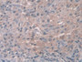 DAB staining on IHC-P; Samples: Human Breast cancer Tissue; Primary Ab: 10µg/ml Rabbit Anti-Human CTSZ Antibody Second Ab: 2µg/mL HRP-Linked Caprine Anti-Rabbit IgG Polyclonal Antibody