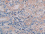 DAB staining on IHC-P; Samples: Human Stomach cancer Tissue; Primary Ab: 30µg/ml Rabbit Anti-Human CTSC Antibody Second Ab: 2µg/mL HRP-Linked Caprine Anti-Rabbit IgG Polyclonal Antibody