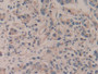 DAB staining on IHC-P; Samples: Human Prostate cancer Tissue; Primary Ab: 10µg/ml Rabbit Anti-Human APBA2 Antibody Second Ab: 2µg/mL HRP-Linked Caprine Anti-Rabbit IgG Polyclonal Antibody