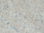 DAB staining on IHC-P; Samples: Human Glioma Tissue; Primary Ab: 30µg/ml Rabbit Anti-Human SNAP25 Antibody Second Ab: 2µg/mL HRP-Linked Caprine Anti-Rabbit IgG Polyclonal Antibody