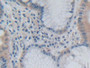 DAB staining on IHC-P; Samples: Human Stomach cancer Tissue;  Primary Ab: 30µg/ml Rabbit Anti-Human
