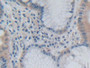 DAB staining on IHC-P; Samples: Human Stomach cancer Tissue)