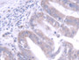 DAB staining on IHC-P; Samples: Human Liver cancer Tissue