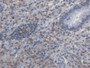 DAB staining on IHC-P; Samples: Human Colorectal cancer Tissue; Primary Ab: 20µg/ml Rabbit Anti-Human SYMPK Antibody Second Ab: 2µg/mL HRP-Linked Caprine Anti-Rabbit IgG Polyclonal Antibody