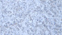 DAB staining on IHC-P; Samples: Human Breast cancer Tissue;  Primary Ab: 20µg/ml Rabbit Anti-Human TNRC6A Antibody Second Ab: 2µg/mL HRP-Linked Caprine Anti-Rabbit IgG Polyclonal Antibody 