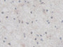 DAB staining on IHC-P; Samples: Human Glioma Tissue;  Primary Ab: 30µg/ml Rabbit Anti-Human TNFaIP3 