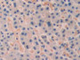 DAB staining on IHC-P; Samples: Human Liver cancer Tissue; Primary Ab: 25µg/ml Rabbit Anti-Human TERF1 Antibody Second Ab: 2µg/mL HRP-Linked Caprine Anti-Rabbit IgG Polyclonal Antibody