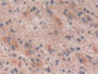DAB staining on IHC-P; Samples: Human Glioma Tissue; Primary Ab: 10µg/ml Rabbit Anti-Human RL Antibody Second Ab: 2µg/mL HRP-Linked Caprine Anti-Rabbit IgG Polyclonal Antibody