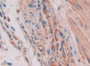 DAB staining on fromalin fixed paraffin- embedded glioma tissue)