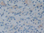 DAB staining on IHC-P; Samples: Human Prostate cancer Tissue; Primary Ab: 10µg/ml Rabbit Anti-Human RL Antibody Second Ab: 2µg/mL HRP-Linked Caprine Anti-Rabbit IgG Polyclonal Antibody