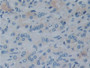 DAB staining on IHC-P;;Samples: Human Prostate cancer Tissue)