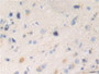 DAB staining on fromalin fixed paraffin- embedded glioma tissue)