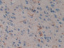 DAB staining on IHC-P; Samples: Human Glioma Tissue; Primary Ab: 10µg/ml Rabbit Anti-Human PSAP Antibody Second Ab: 2µg/mL HRP-Linked Caprine Anti-Rabbit IgG Polyclonal Antibody