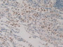 DAB staining on IHC-P; Samples: Human Lung Cancer Tissue)